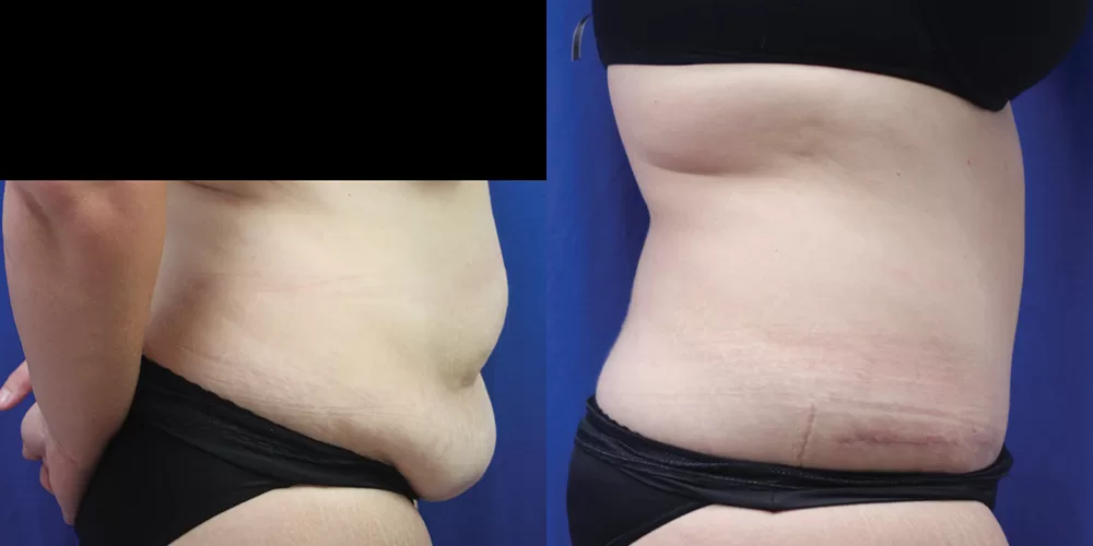Moratis plastic surgery tummy tuck patient 38c