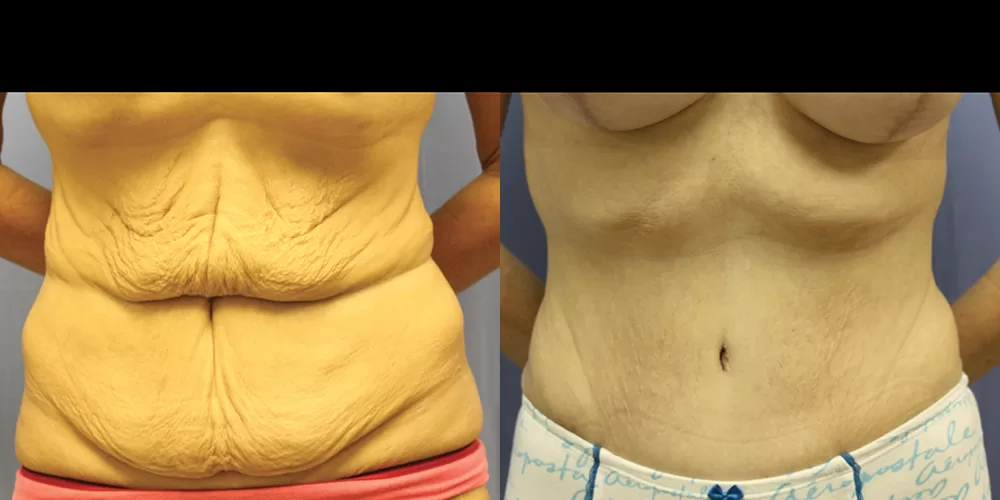 Moratis plastic surgery tummy tuck patient 39a