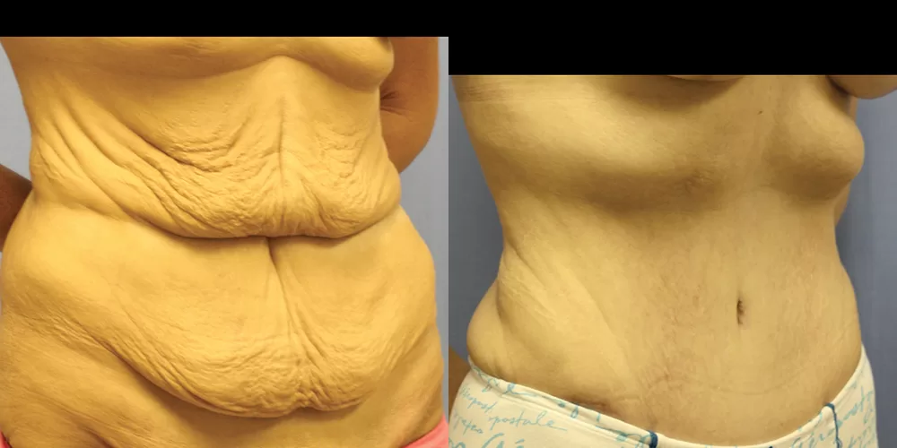 Moratis plastic surgery tummy tuck patient 39b
