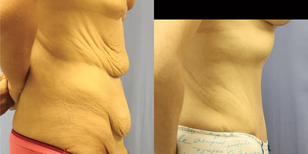 Moratis plastic surgery tummy tuck patient 39c
