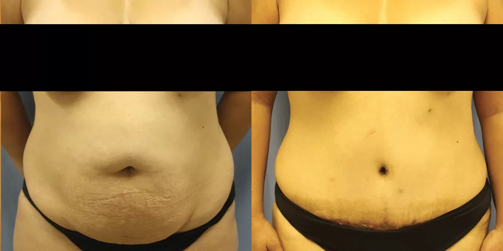 Moratis plastic surgery tummy tuck patient 40a