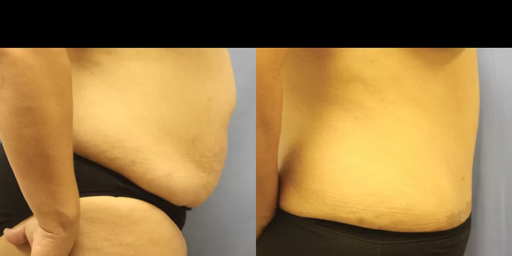 Moratis plastic surgery tummy tuck patient 40c