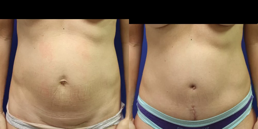 Moratis plastic surgery tummy tuck patient 41a