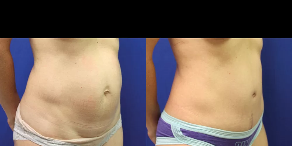 Moratis plastic surgery tummy tuck patient 41b