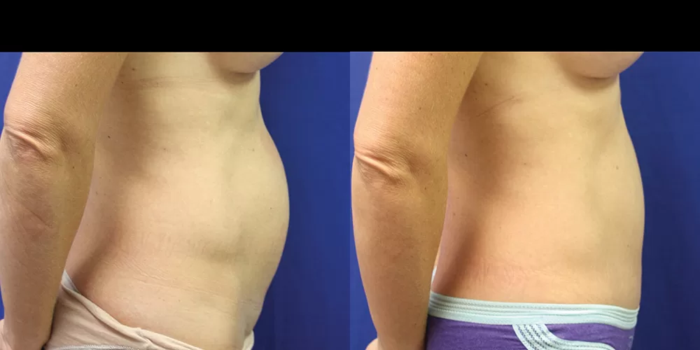 Moratis plastic surgery tummy tuck patient 41c