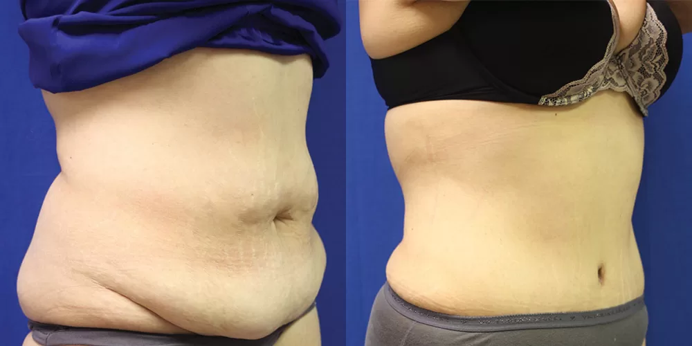 Moratis plastic surgery tummy tuck patient 42b