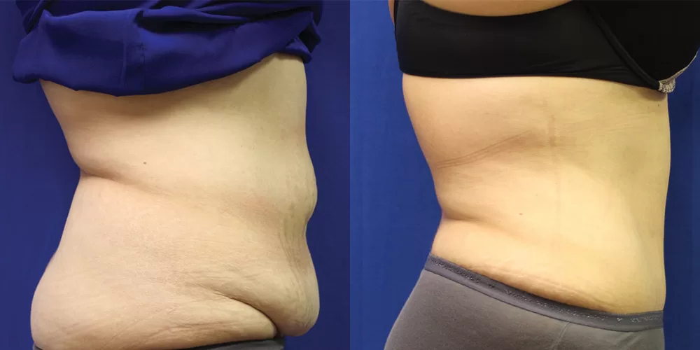 Moratis plastic surgery tummy tuck patient 42c