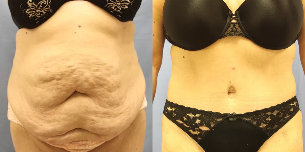Moratis plastic surgery tummy tuck patient 43a
