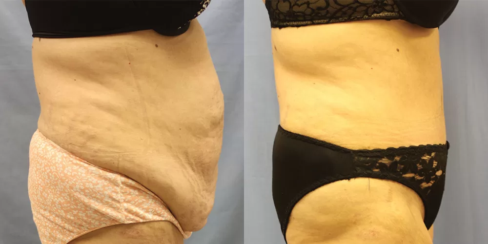 Moratis plastic surgery tummy tuck patient 43c
