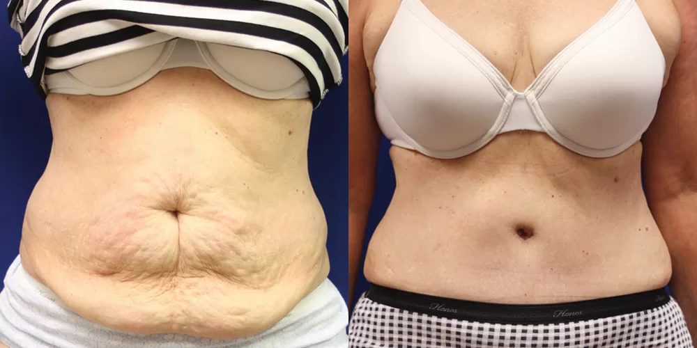 Moratis plastic surgery tummy tuck patient 44a