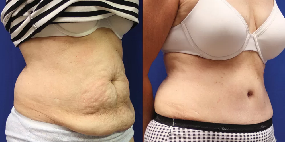 Moratis plastic surgery tummy tuck patient 44b
