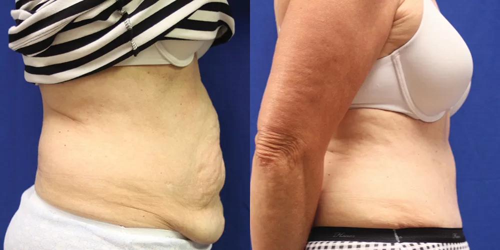 Moratis plastic surgery tummy tuck patient 44c