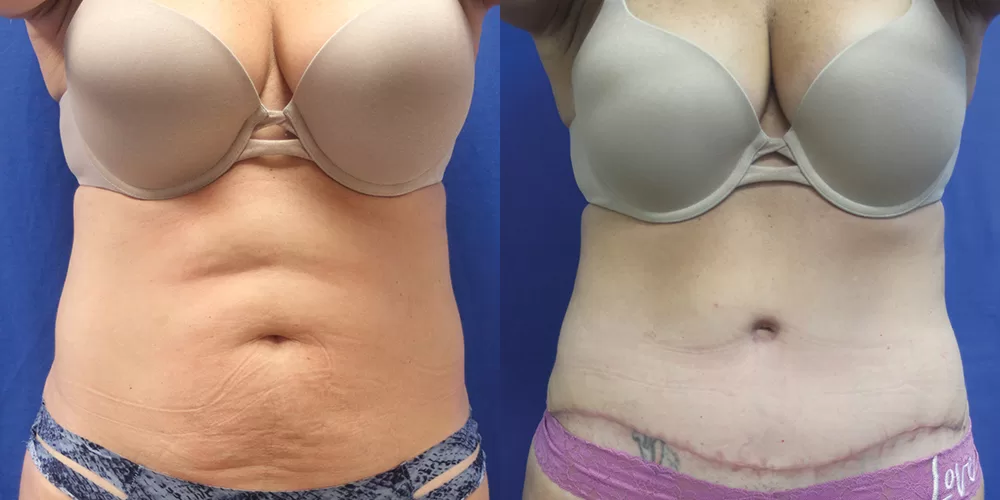 Moratis plastic surgery tummy tuck patient 45a