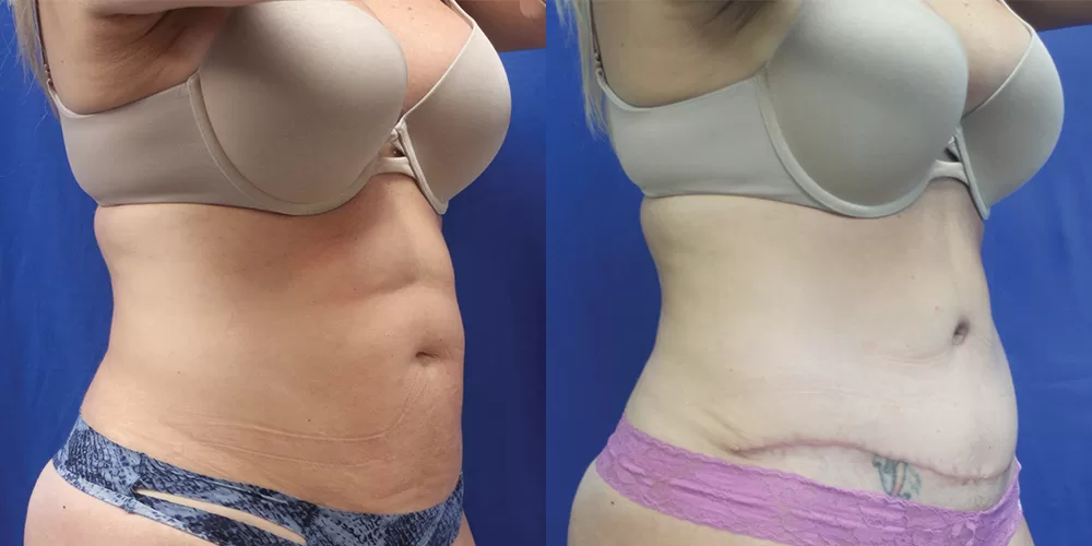 Moratis plastic surgery tummy tuck patient 45b