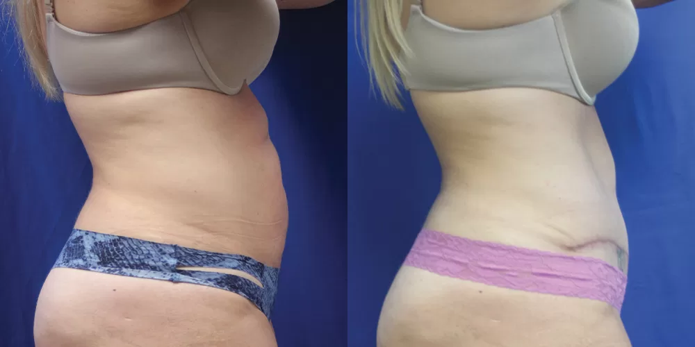 Moratis plastic surgery tummy tuck patient 45c