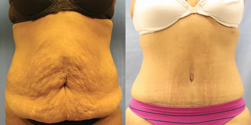 Moratis plastic surgery tummy tuck patient 46a