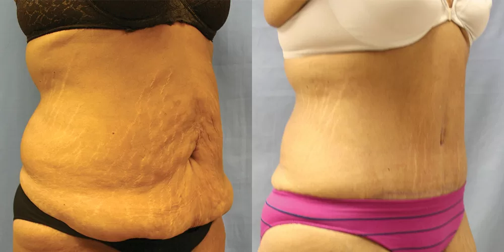 Moratis plastic surgery tummy tuck patient 46b