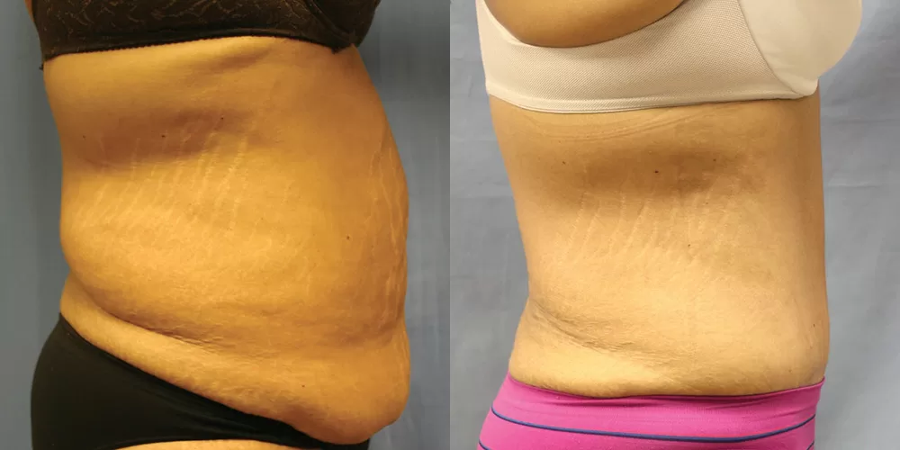 Moratis plastic surgery tummy tuck patient 46c
