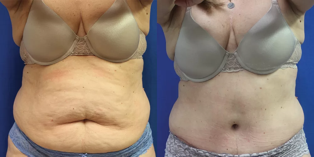 Moratis plastic surgery tummy tuck patient 47a