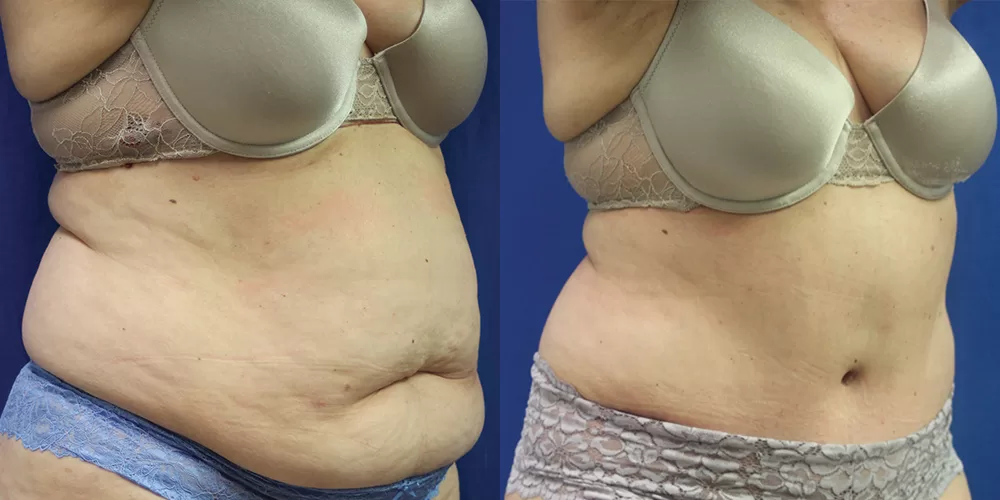 Moratis plastic surgery tummy tuck patient 47b