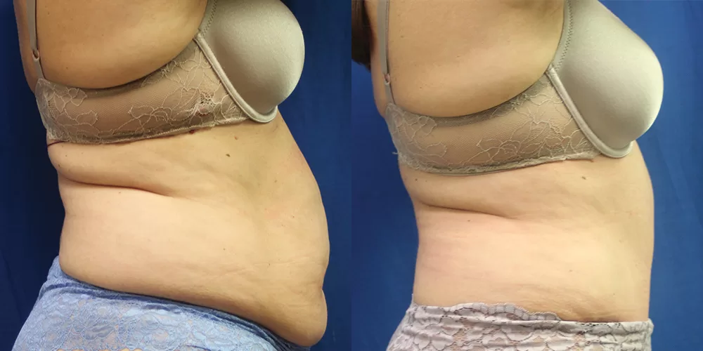 Moratis plastic surgery tummy tuck patient 47c