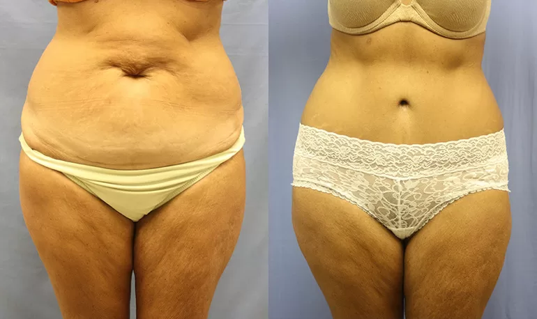 Patient 4a tummy tuck before and after