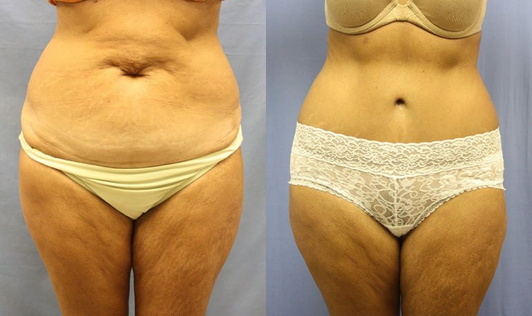 Patient 4a Tummy Tuck Before and After