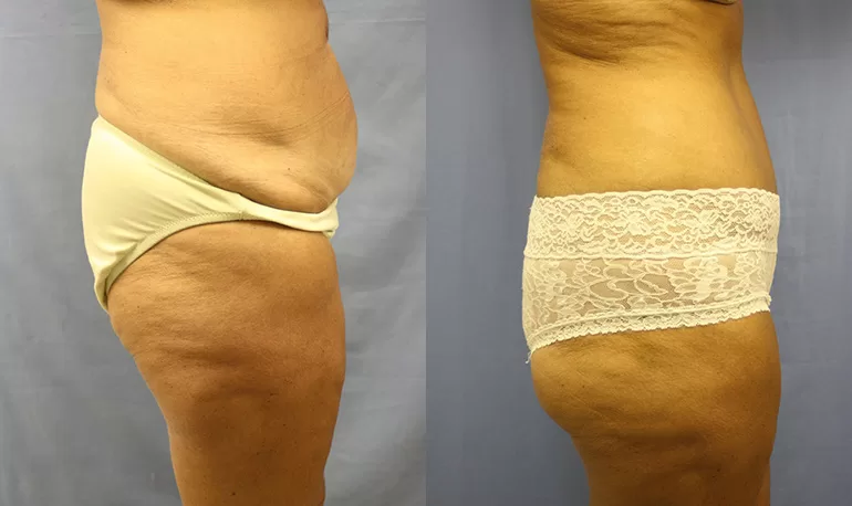 Patient 4b tummy tuck before and after