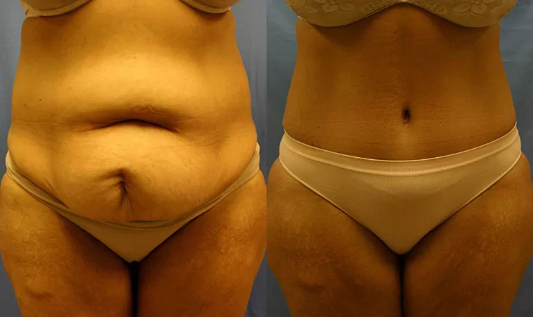 Patient 5a tummy tuck before and after