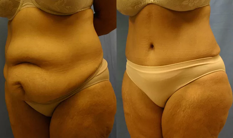 Patient 5b tummy tuck before and after