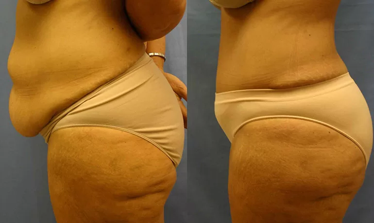 Patient 5c tummy tuck before and after