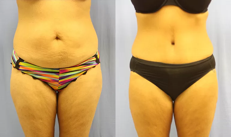 Patient 6a tummy tuck before and after