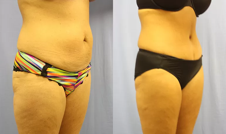 Patient 6b tummy tuck before and after