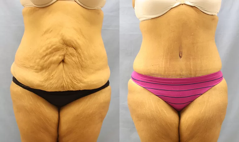 Patient 7a tummy tuck before and after