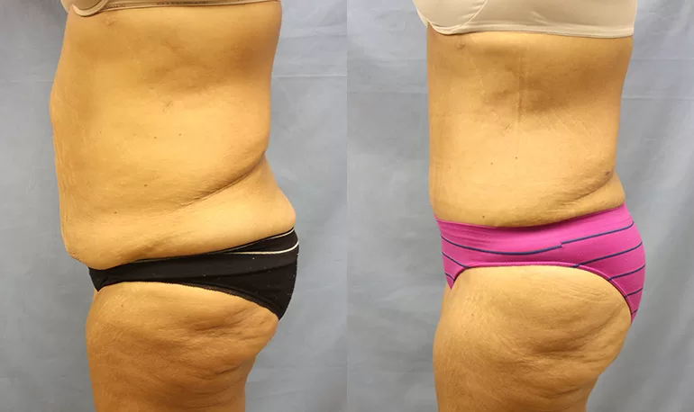 Patient 7b tummy tuck before and after