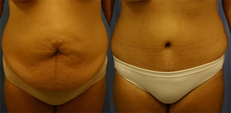 Patient 1a tummy tuck before and after
