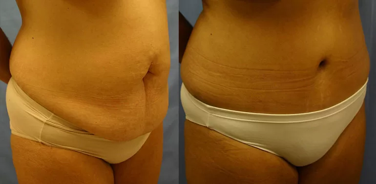 Patient 1b tummy tuck before and after
