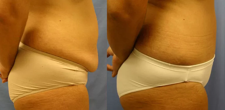 Patient 1c tummy tuck before and after
