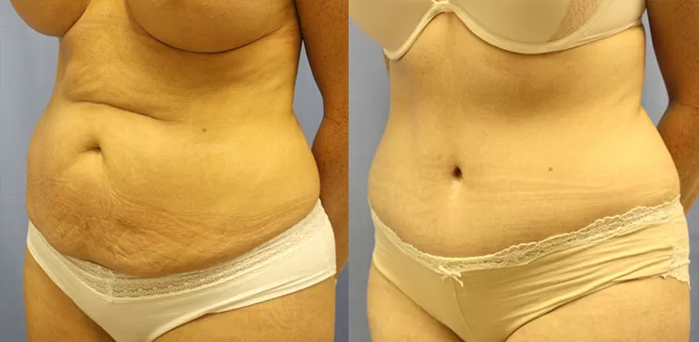 Patient 2a tummy tuck before and after