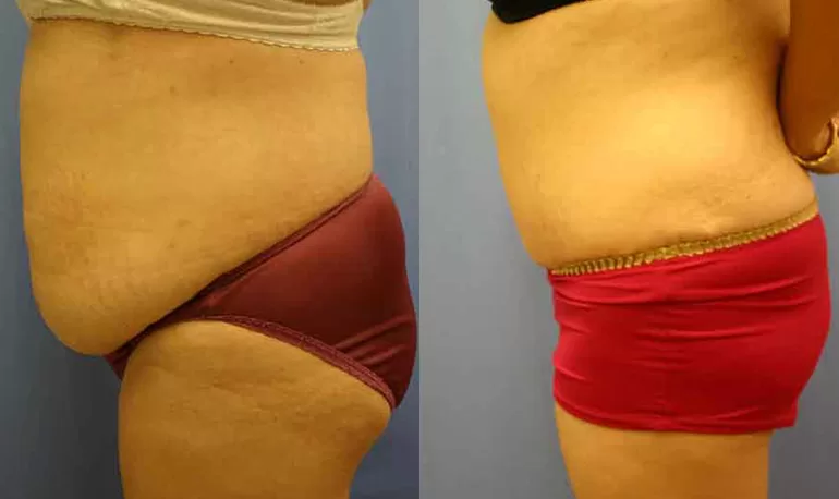 Patient 3a tummy tuck before and after