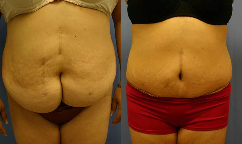 Patient 3b tummy tuck before and after