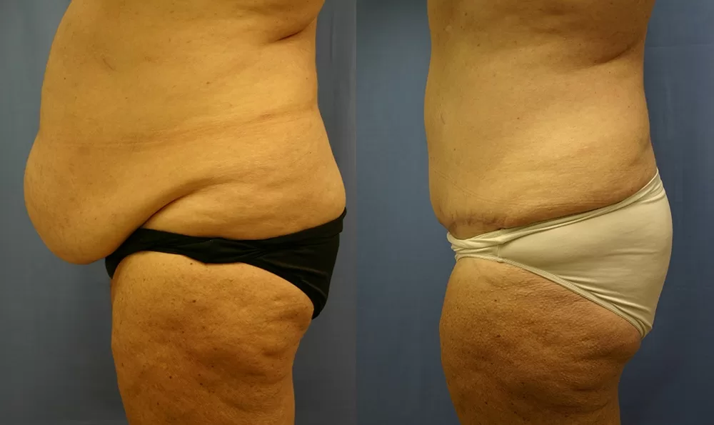 Patient 18b tummy tuck before and after
