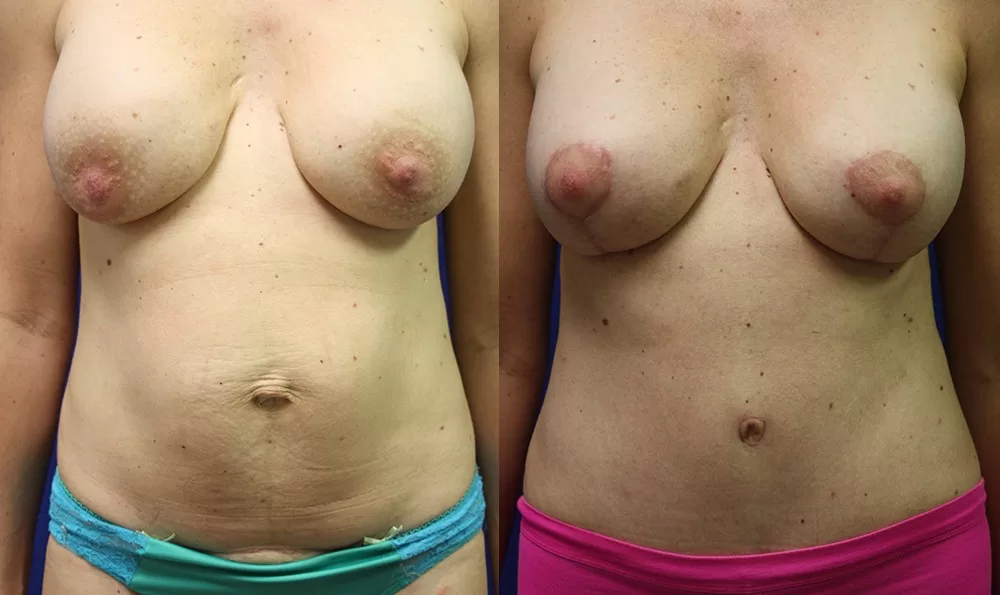 Patient 19a tummy tuck before and after