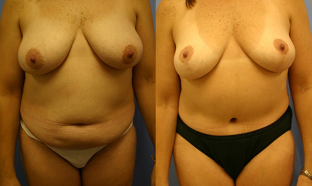 Patient 12a Tummy Tuck Before and After