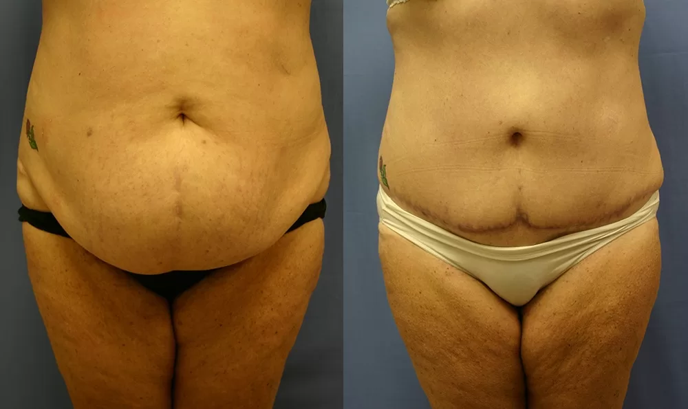 Patient 18a tummy tuck before and after