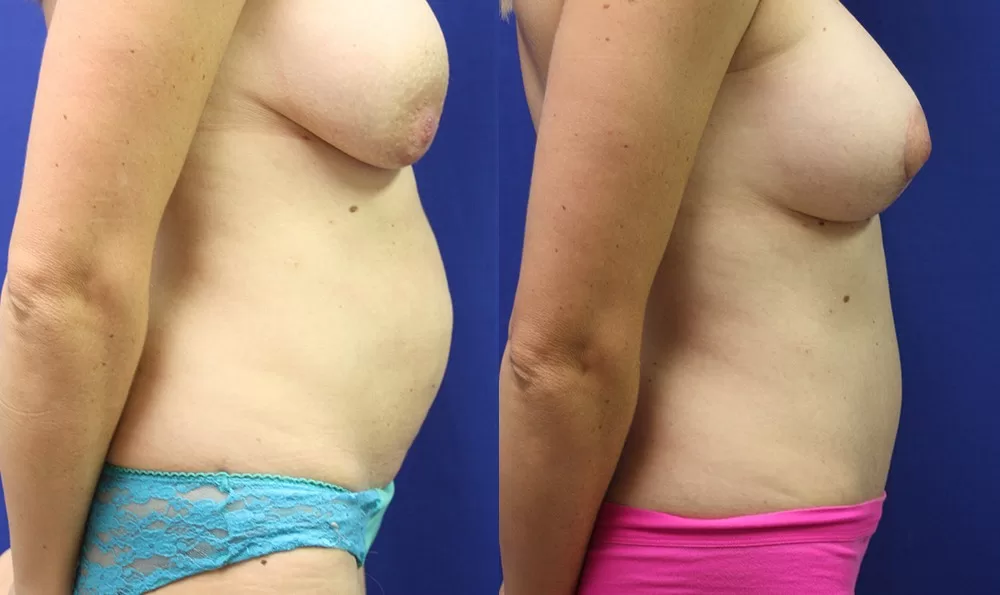 Patient 19b tummy tuck before and after