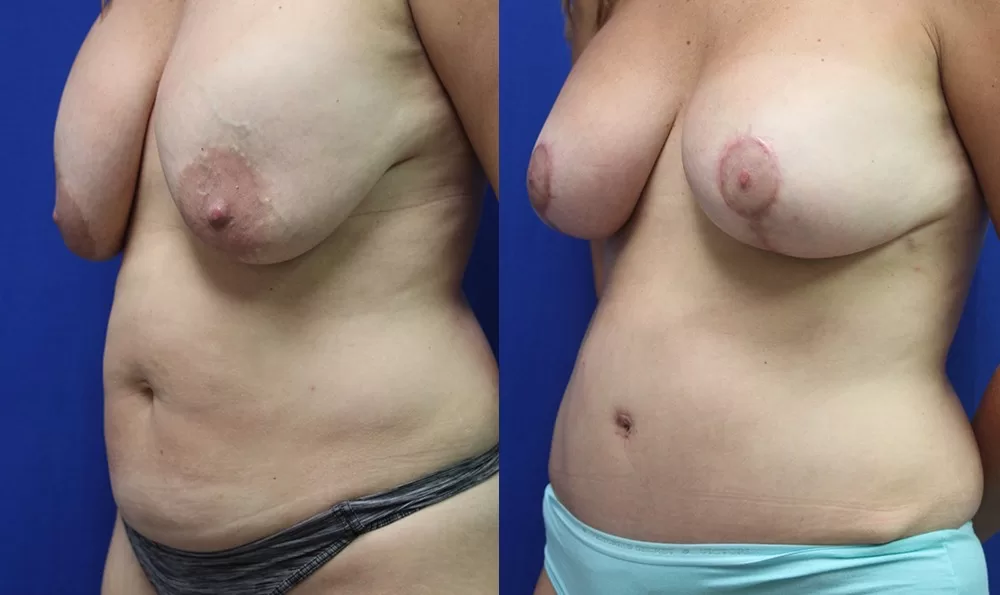 Patient 20b tummy tuck before and after