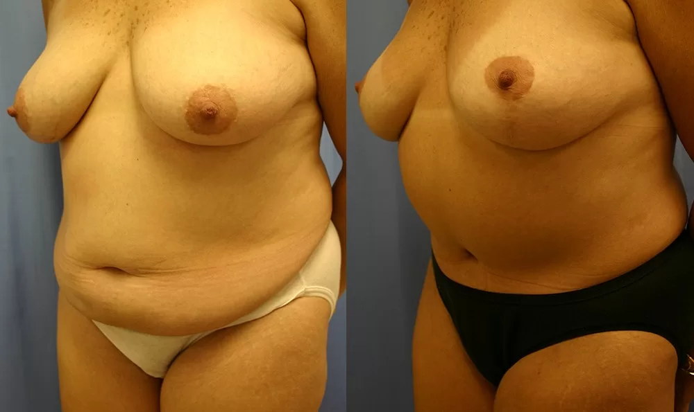 Patient 12b tummy tuck before and after