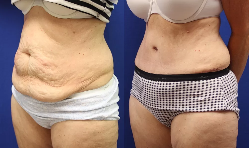 Patient 17a tummy tuck before and after