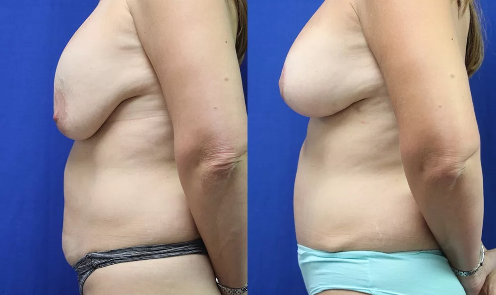 Patient 20c tummy tuck before and after